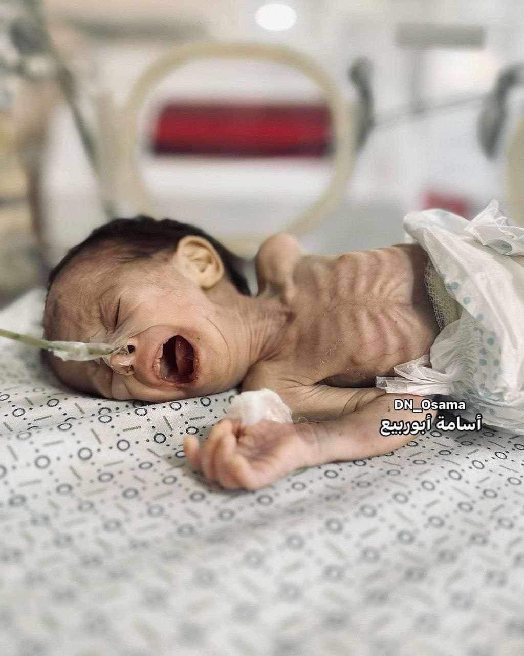 Bébé palestinienne décédée de malnutrition à Gaza