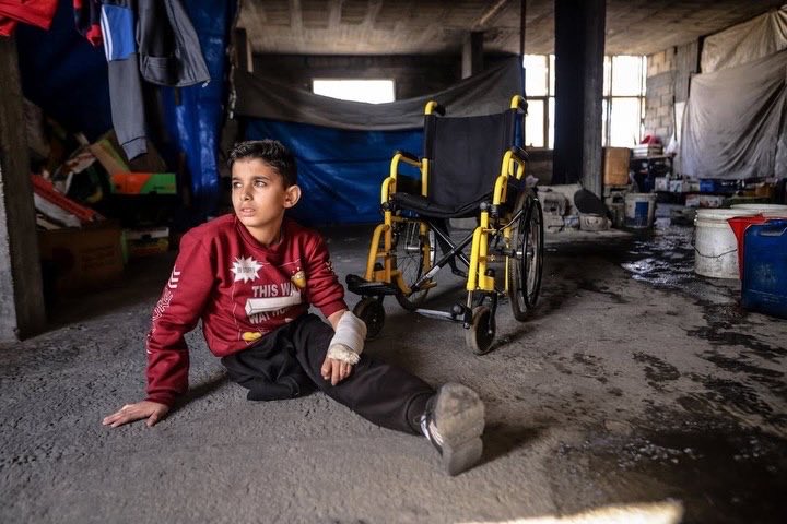 Twelve-Year-Old Mohammed Loses Leg in Israeli Strike