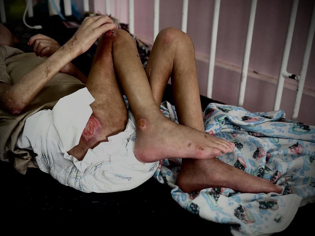 Gaza Children Suffering Without Medical Treatment Access