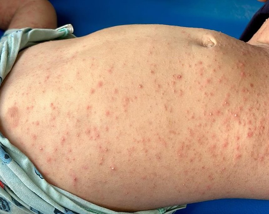 Skin Diseases Spread Among Displaced Palestinians Due to Water Shortage
