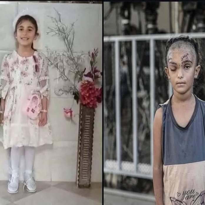 Palestinian Girl Injured in Israeli Airstrike on Gaza School