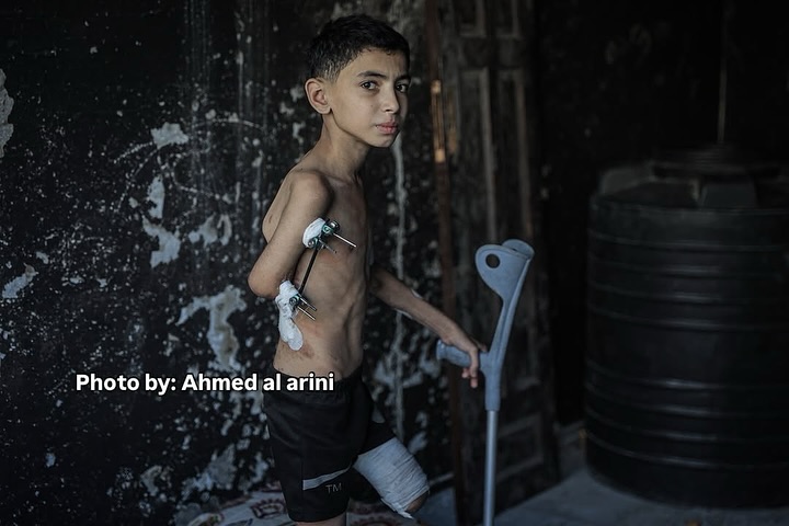 Child Samir Zaqout injured in Israeli strike on Gaza home