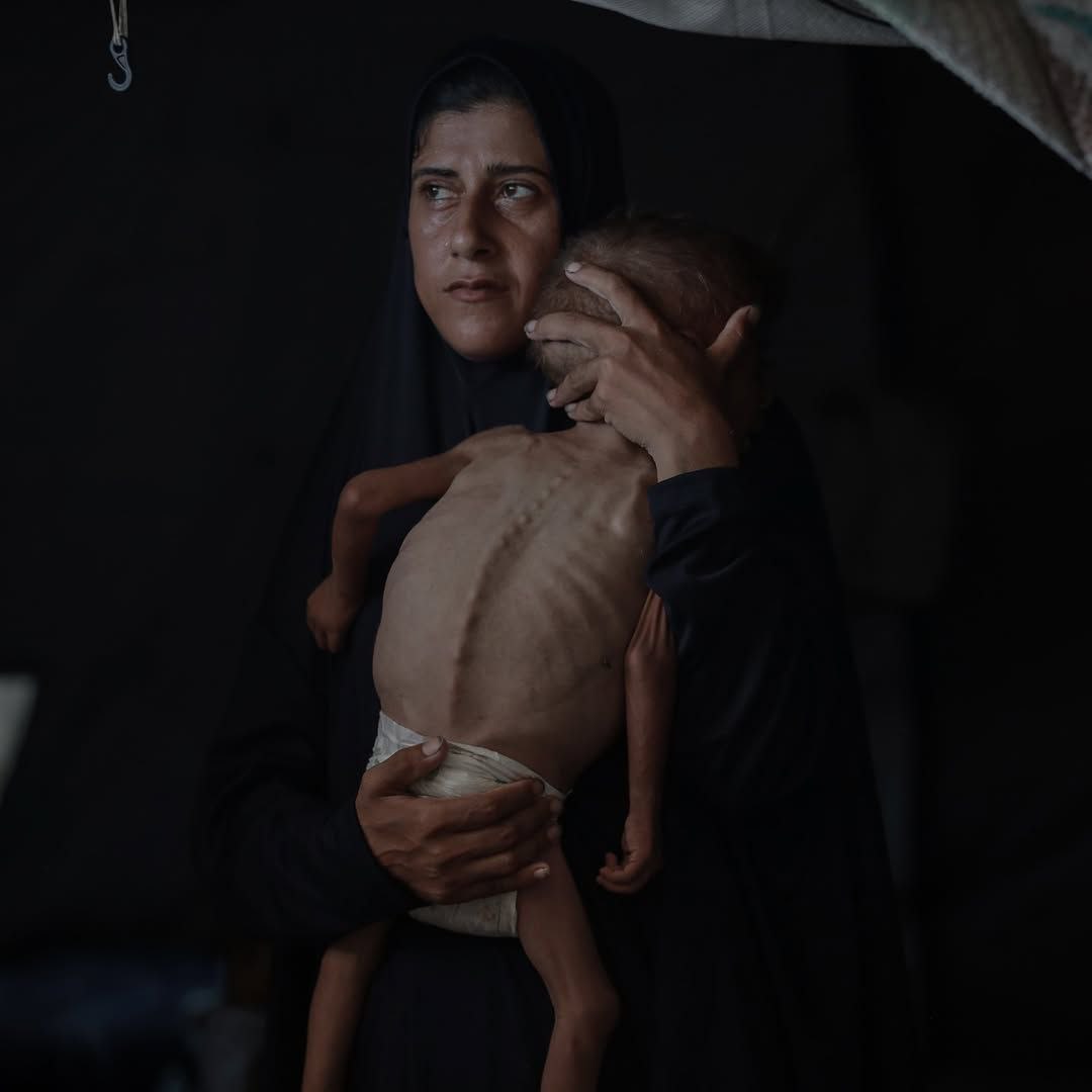 Over 100 Children Dead from Hunger in Gaza Conflict