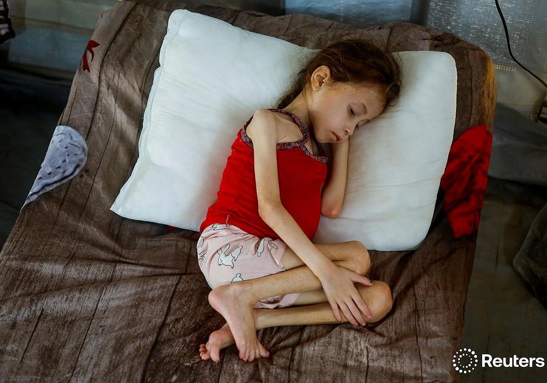 Palestinian Child Jana Ayyad at Risk from Malnutrition in Gaza