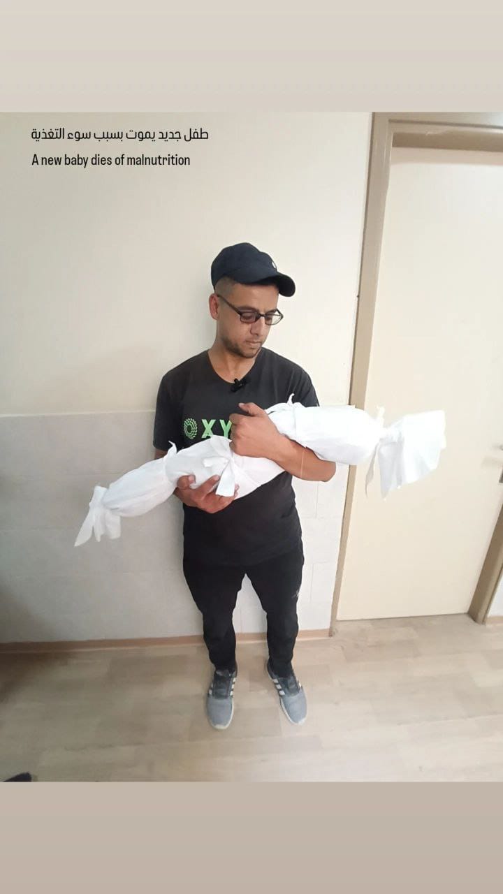 Palestinian Child Dies from Malnutrition in Northern Gaza Strip