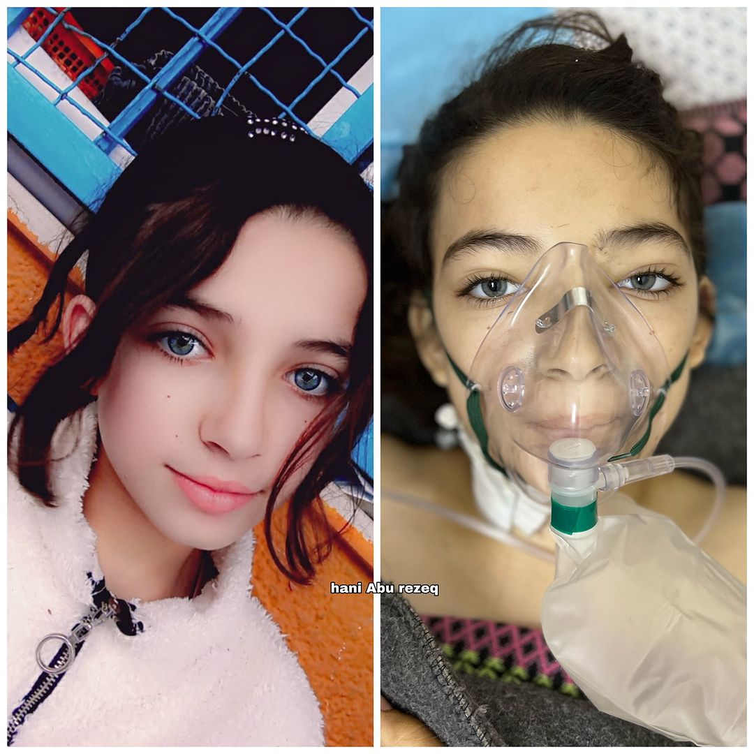 13-year-old girl injured in Israeli airstrike on school