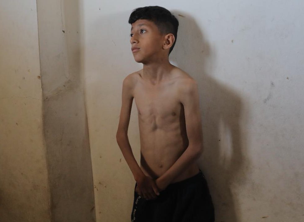 Israeli ban on food and aid worsens child malnutrition crisis Gaza