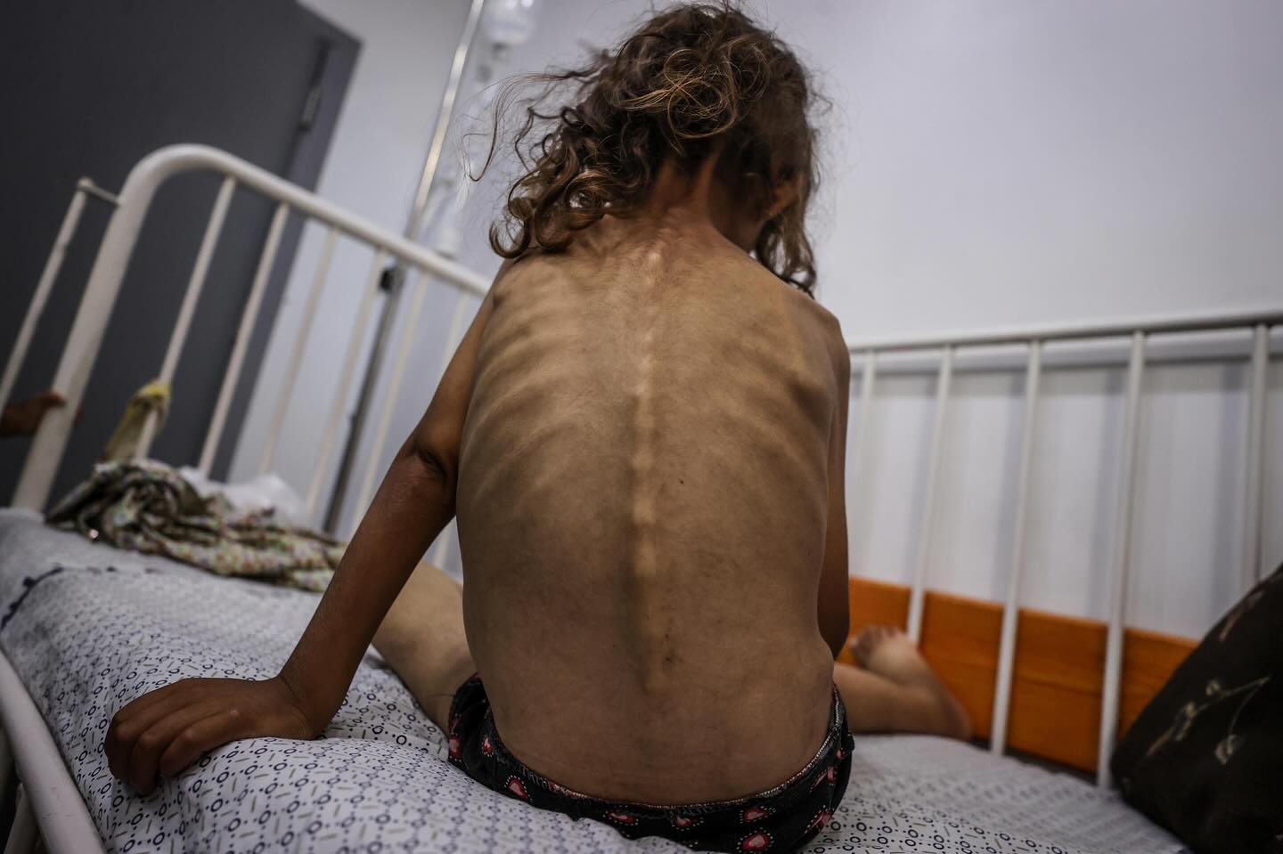 Seven-Year-Old May Abu Arar Faces Life-Threatening Malnutrition Crisis