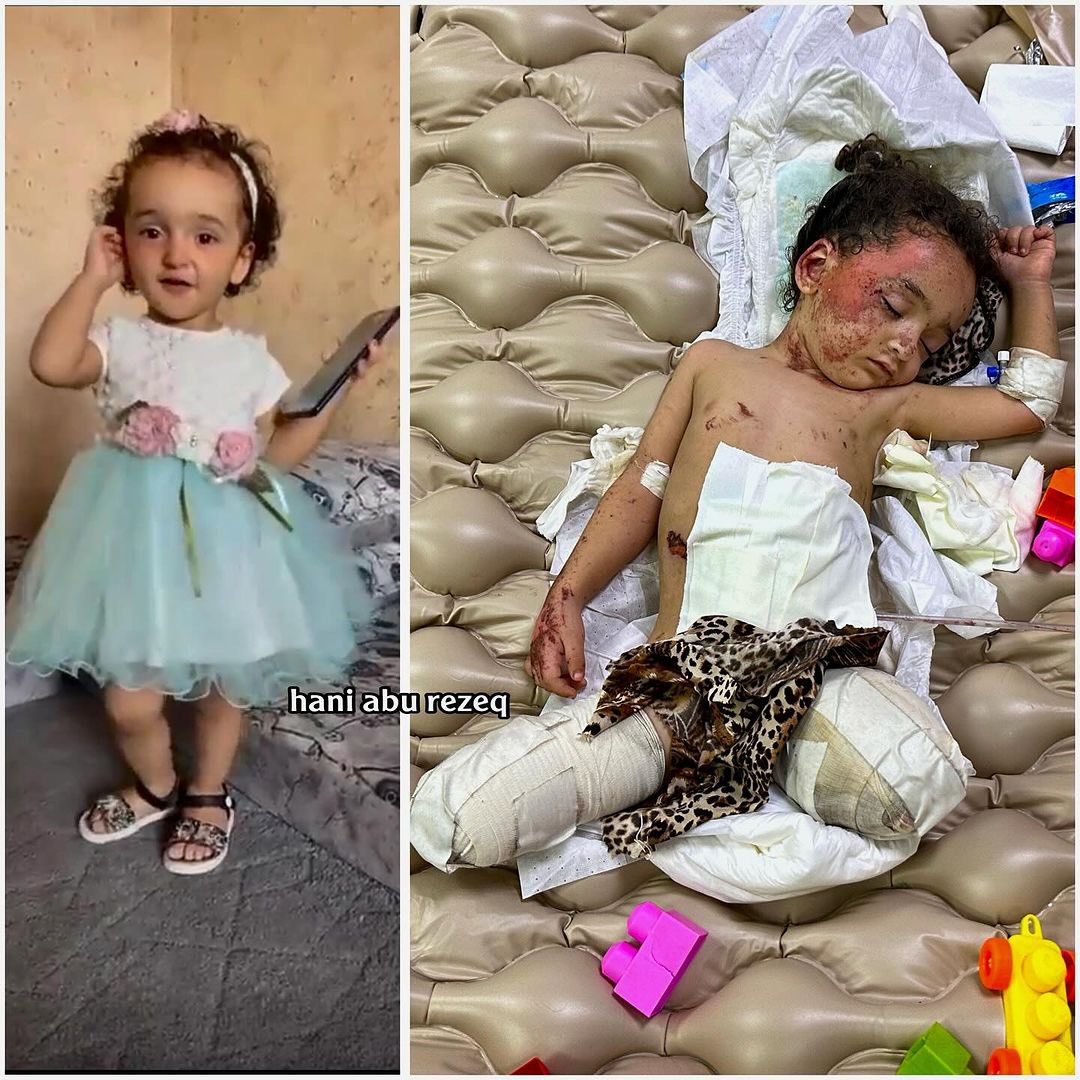 Three-Year-Old Hanan Loses Legs and Mother in Airstrike