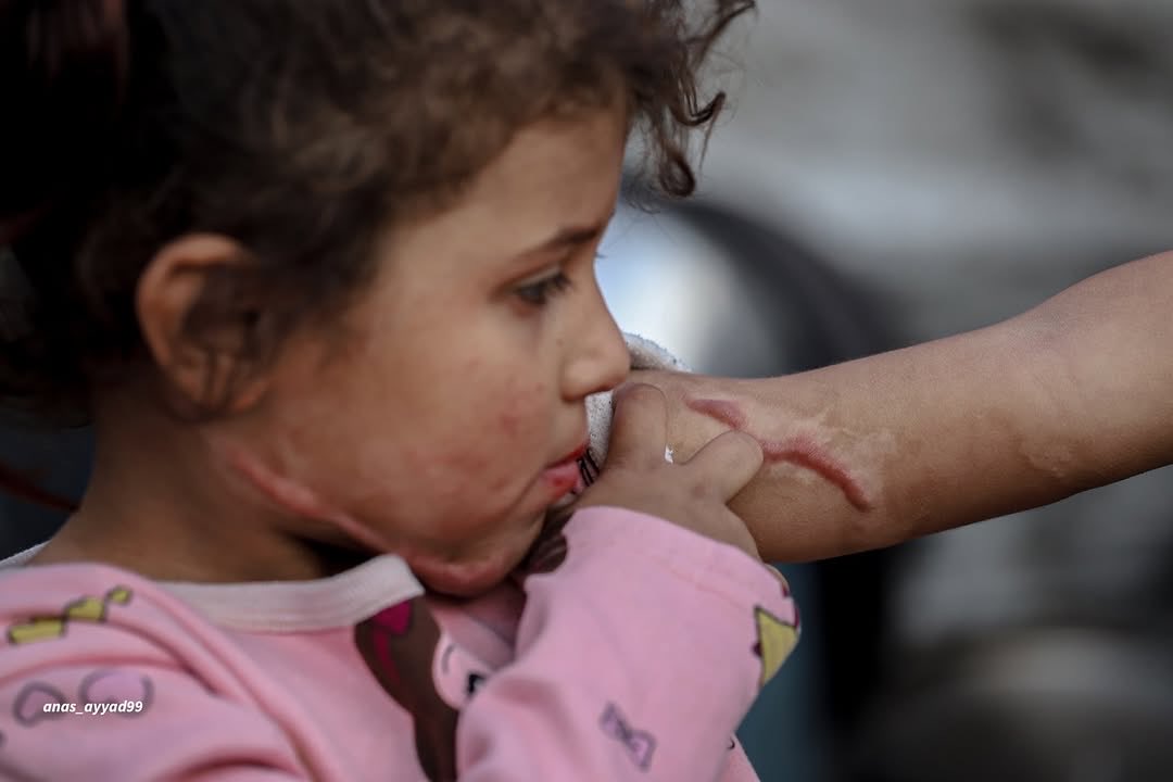 Gaza child Rital suffers severe burns from Israeli drone attack