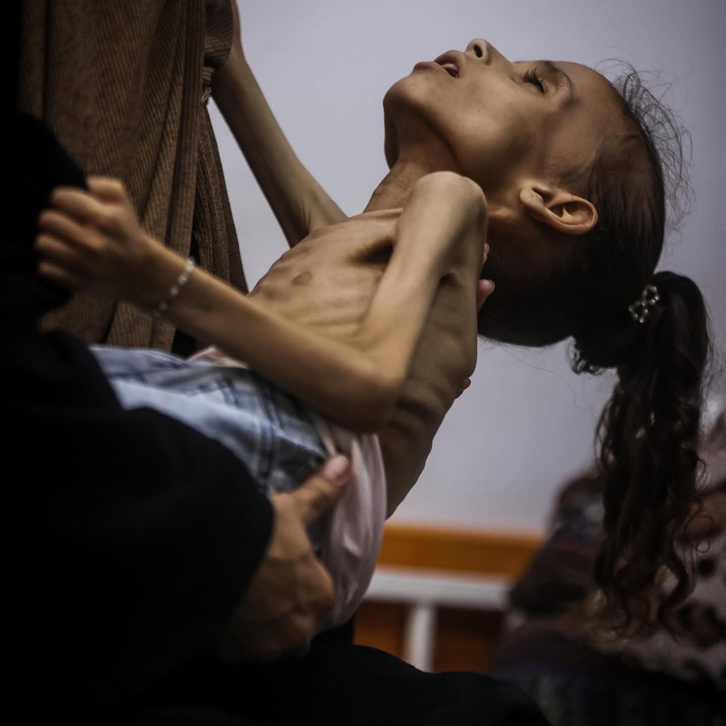 9-Year-Old Maryam Duvvas Critical From Malnutrition in Gaza Blockade