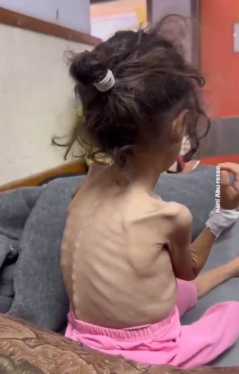 Gaza Children Face Severe Malnutrition Crisis Daily