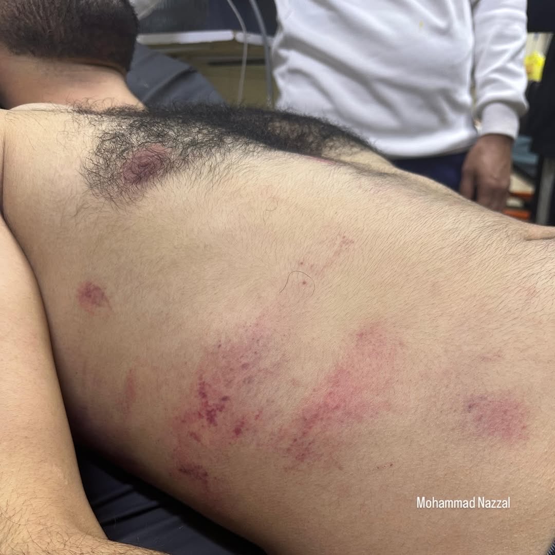 Three injured from Qraqe village treated at hospital