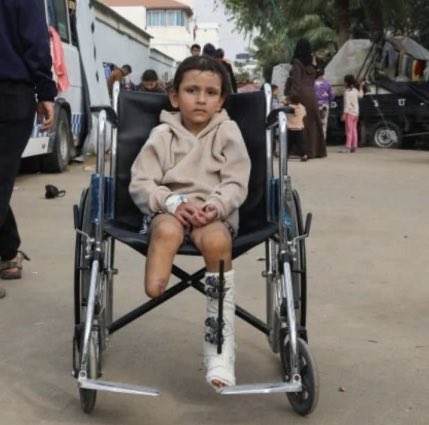 Israeli attacks cause children to lose limbs Gaza