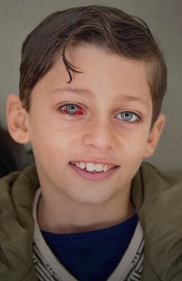 Child loses vision from Gaza strike, thousands suffer similar injuries