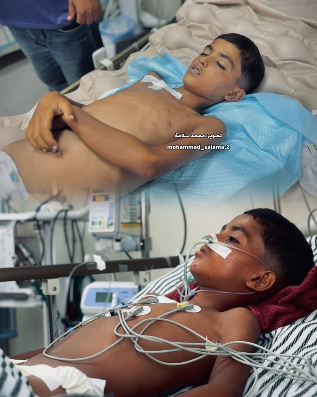 Palestinian child dies of polio at Nasser Medical Complex