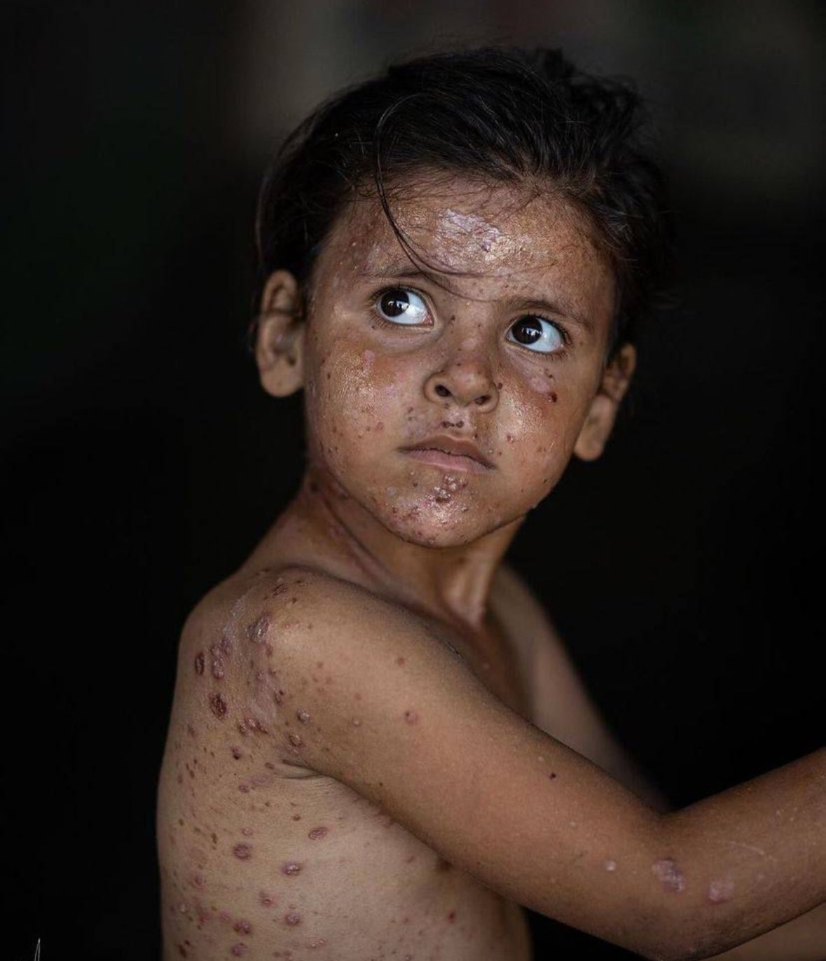 UN ceasefire request for Gaza vaccination denied by Israel