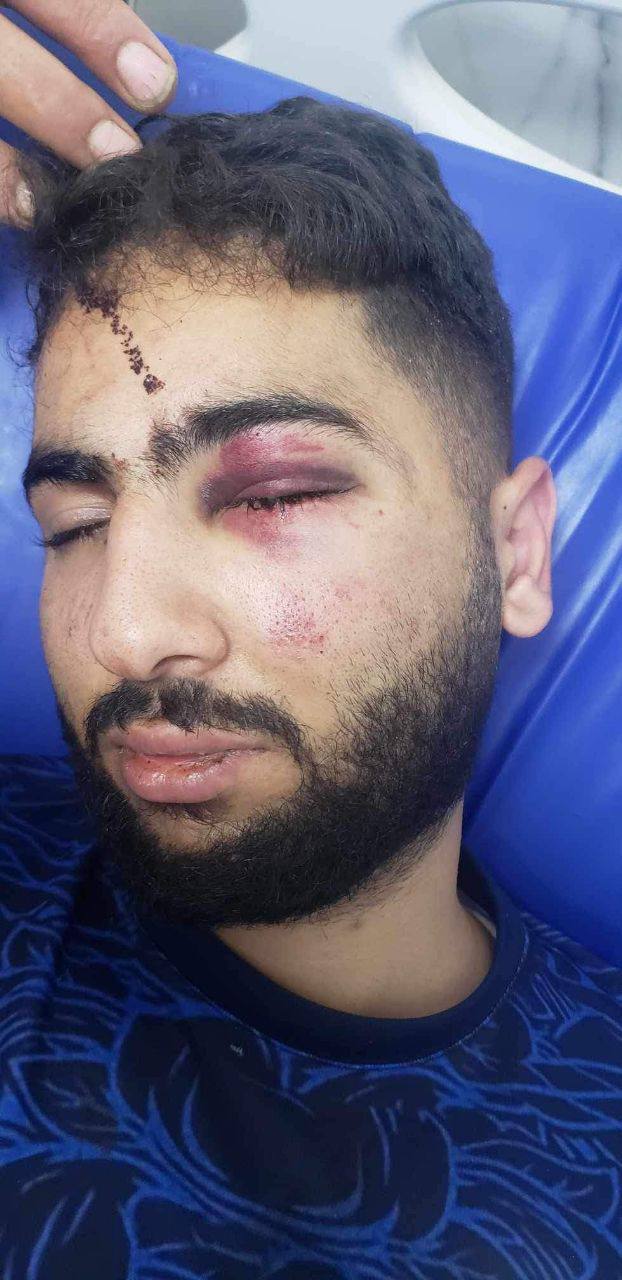Israeli forces brutally assault Palestinian man Adam Sharif Na’san
