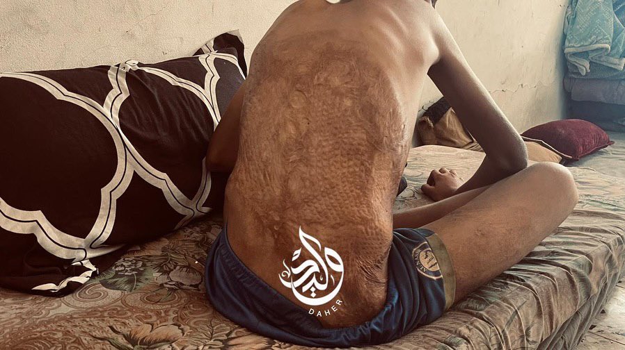 Orphaned Child Anas Severely Burned in Northern Gaza Conflict