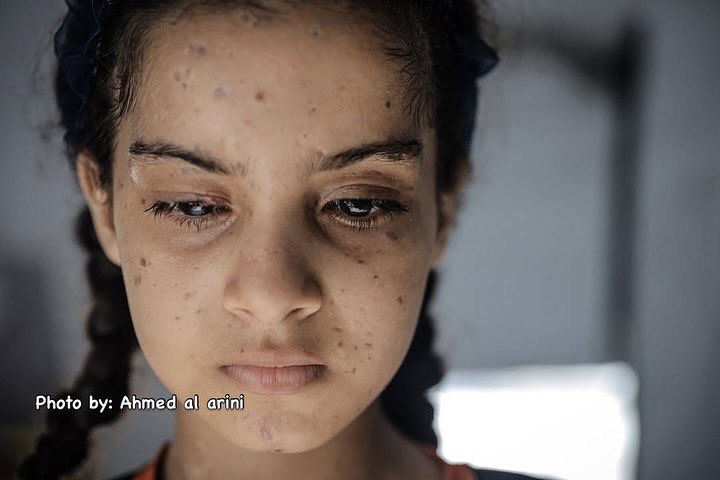 11-Year-Old Maria Loses Eyesight in Gaza Israeli Attack