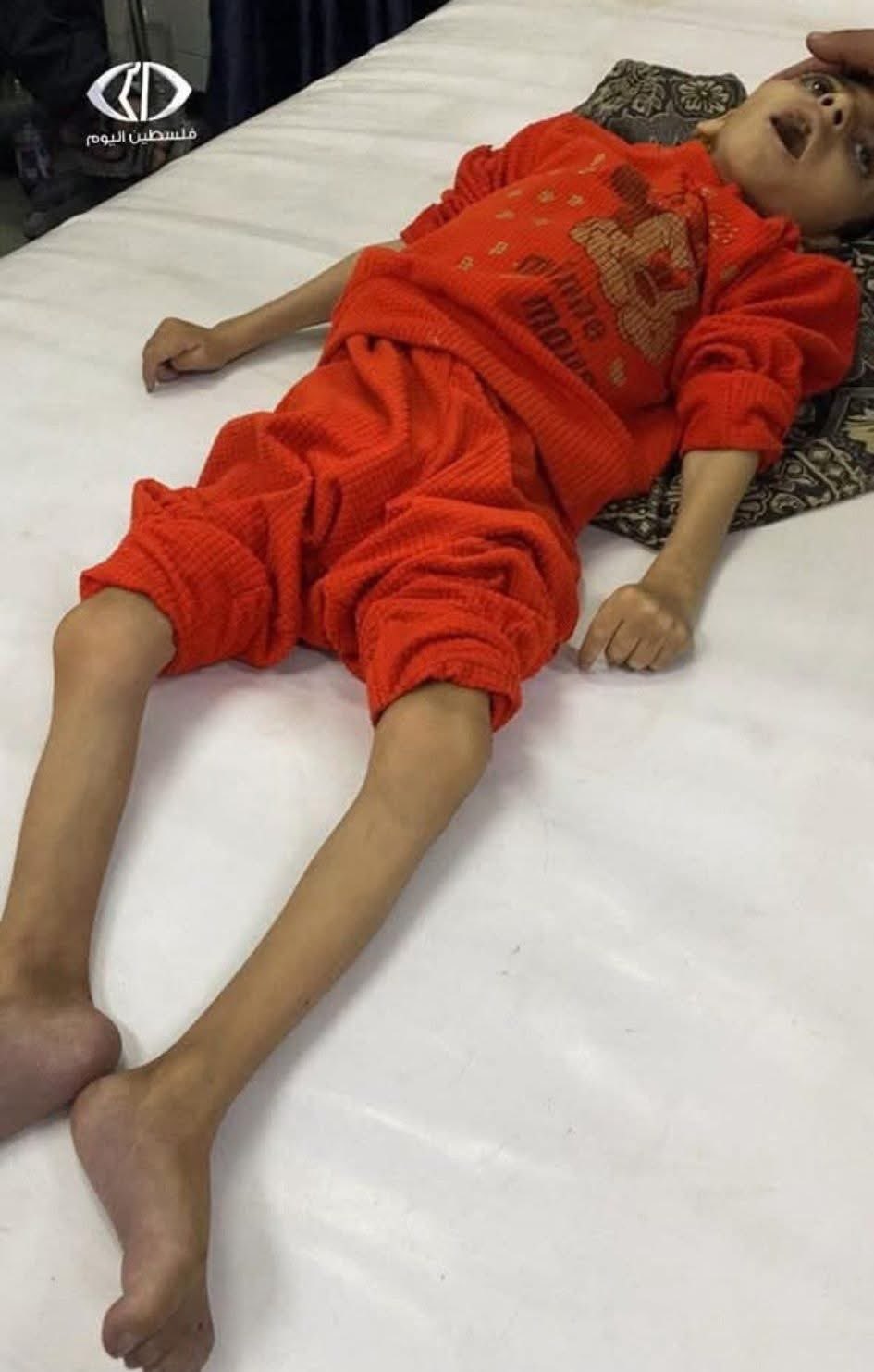 Child Dies from Starvation in Gaza Conflict