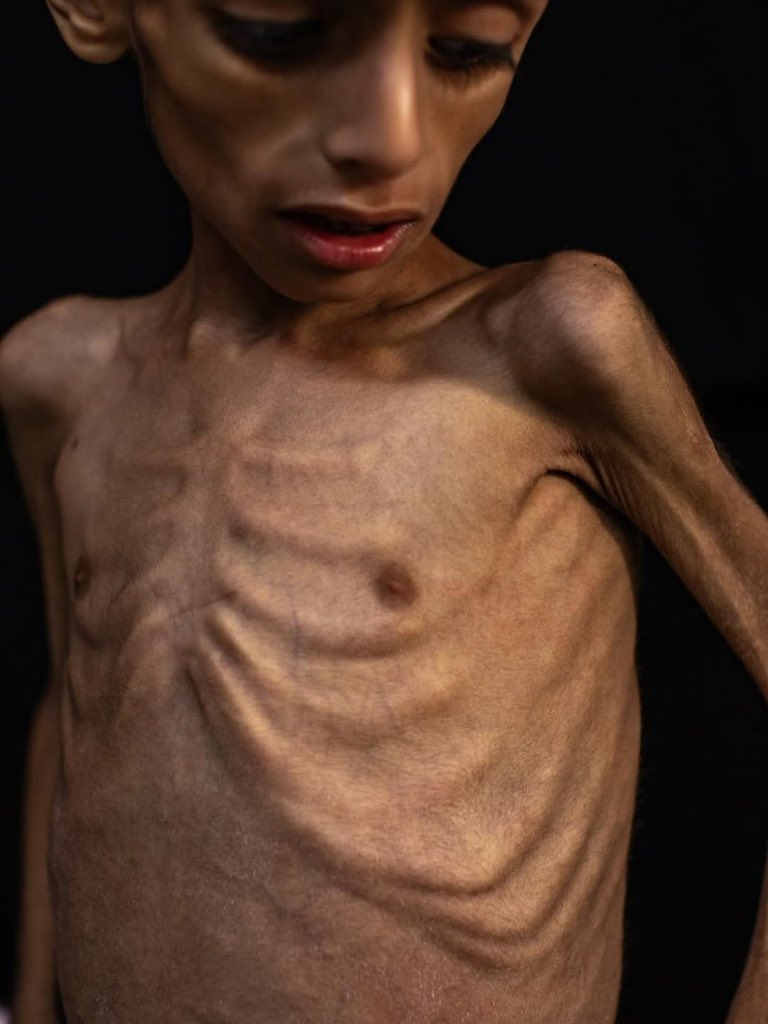 Malnutrition and Dehydration Crisis in Gaza