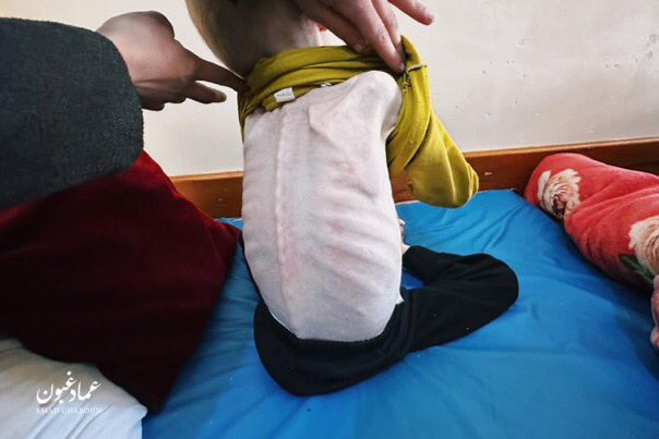 6-Year-Old Child Faces Malnutrition Crisis Gaza Hospital