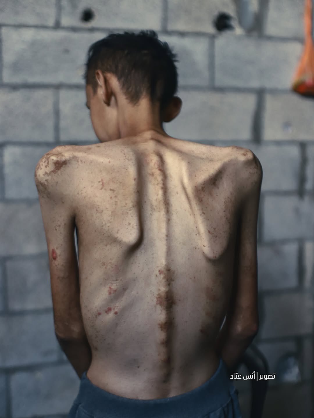 Ahmed Alaa Al-Batniji: Celiac Disease Crisis During Siege