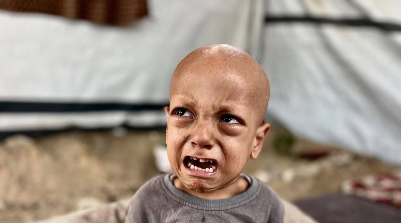 Child from Gaza hunger photo dies from severe malnutrition