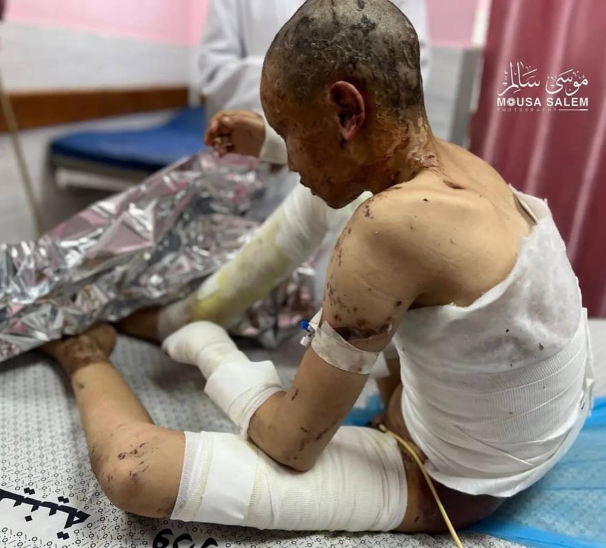 12-Year-Old Omar Suffers Severe Burns From Israeli Airstrike