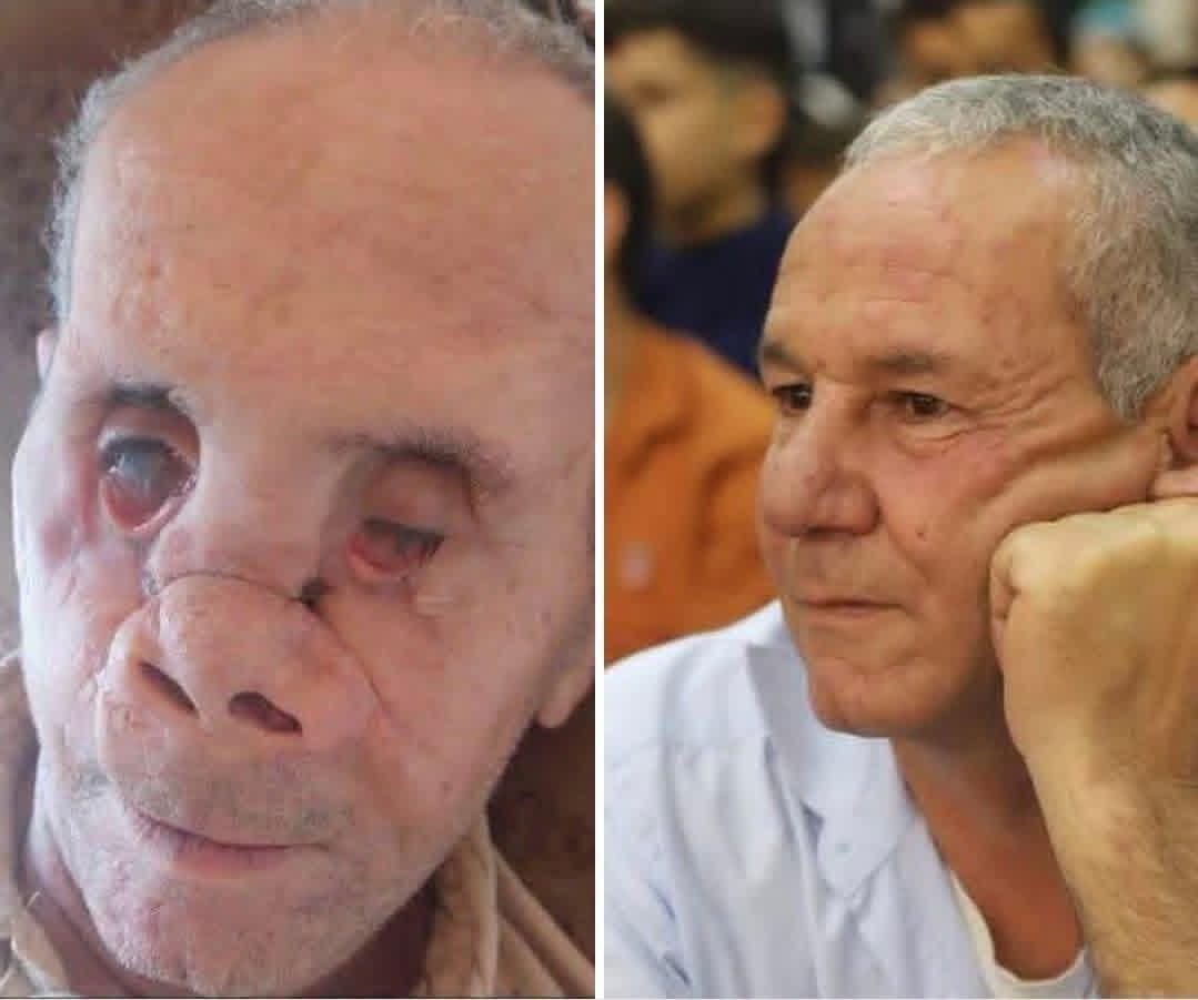 Before and after: a life changed forever by Israeli missiles in Gaza