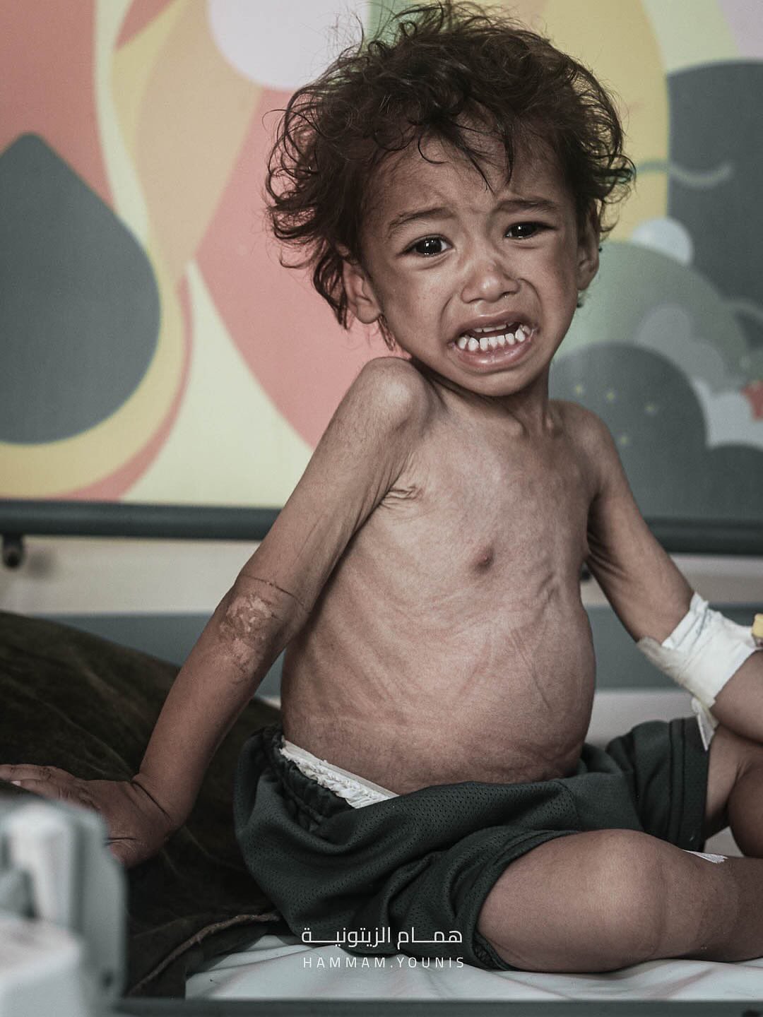 Children in Gaza Face Severe Hunger and Malnutrition Crisis
