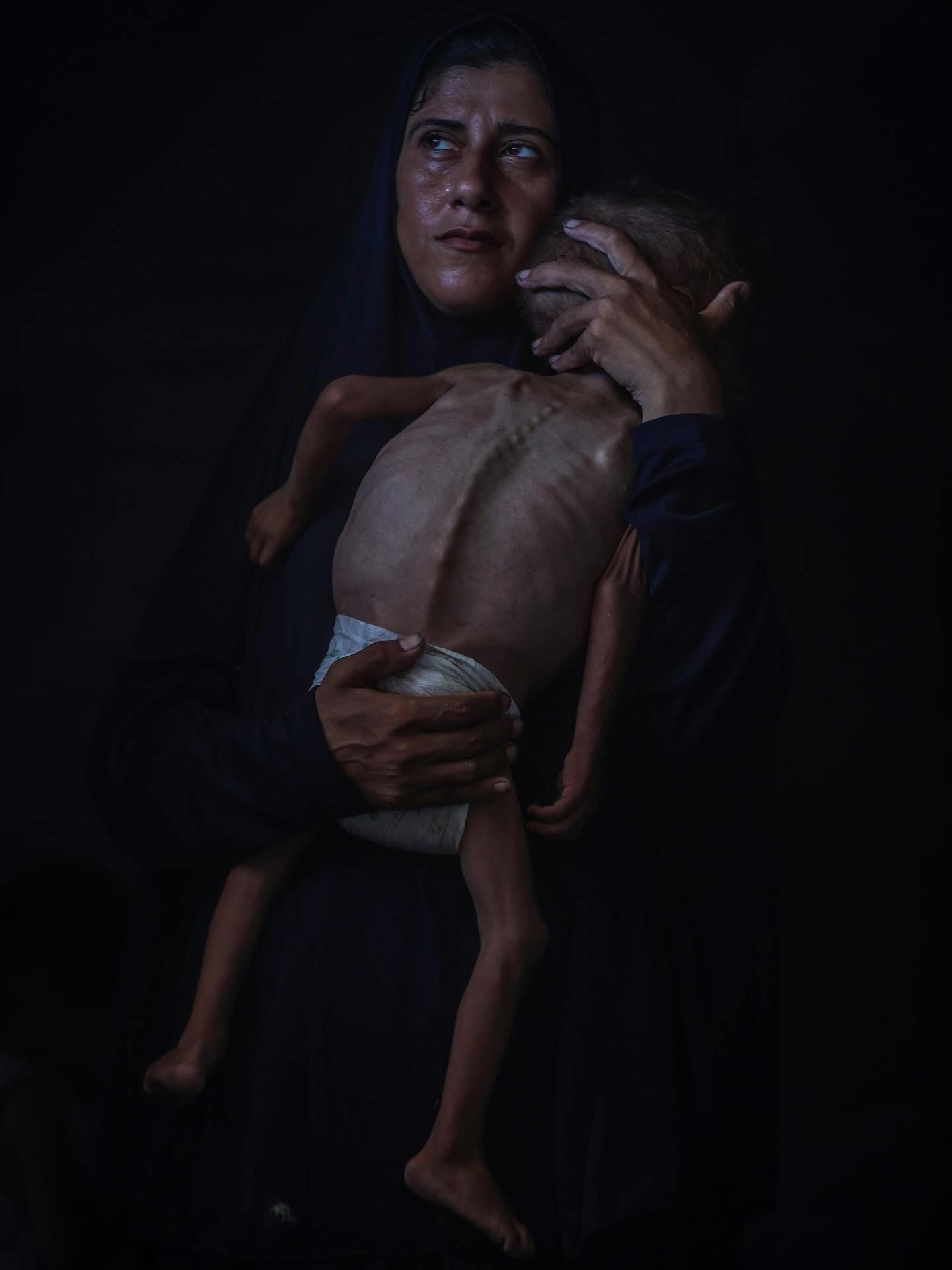 Gaza Ministry of Health Reports 122 Child Deaths From Malnutrition
