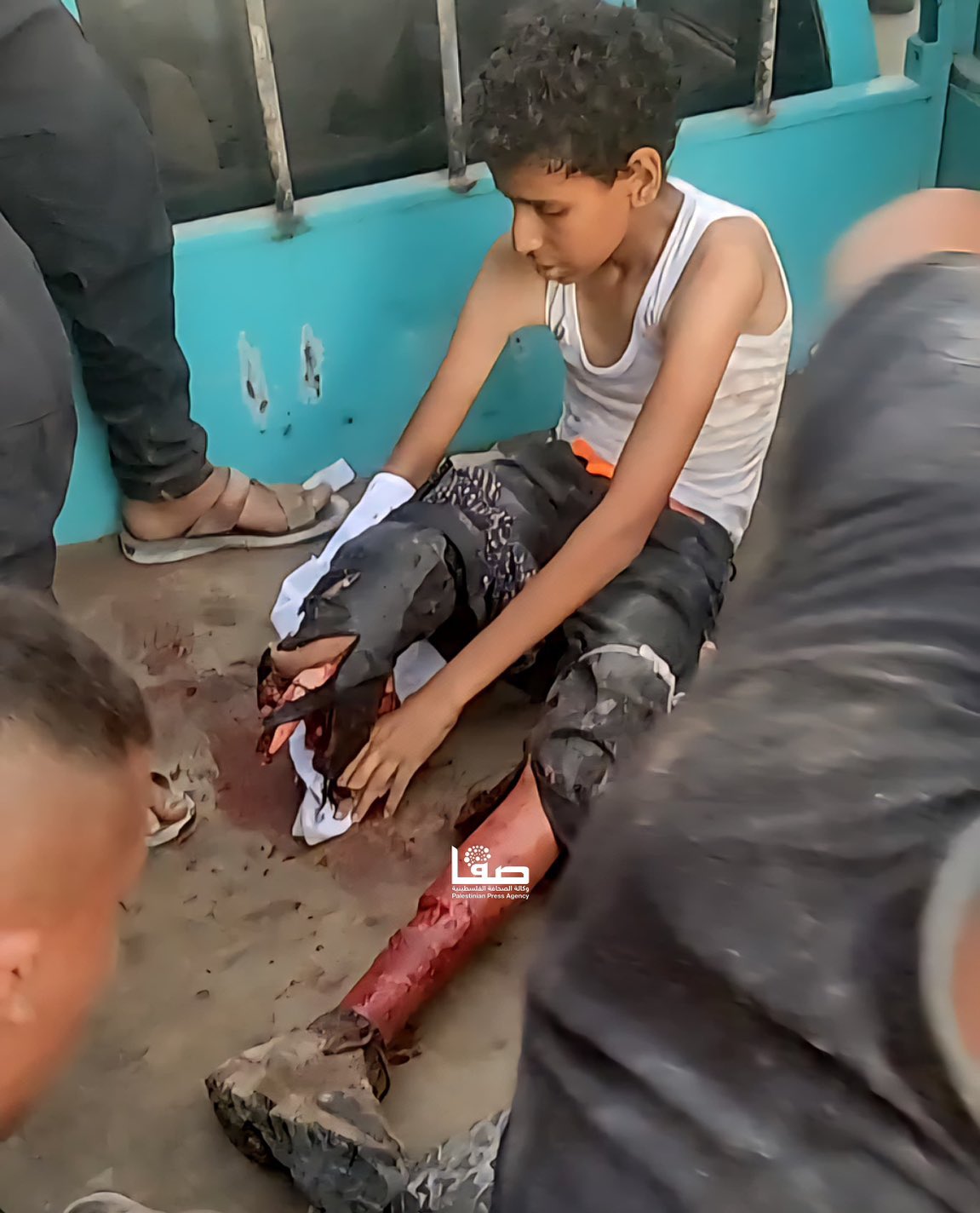 Palestinian Child Loses Leg in Israeli Airstrike on Gaza Home