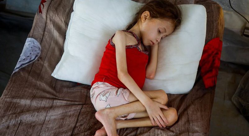112 Gaza Children Diagnosed with Acute Malnutrition Daily