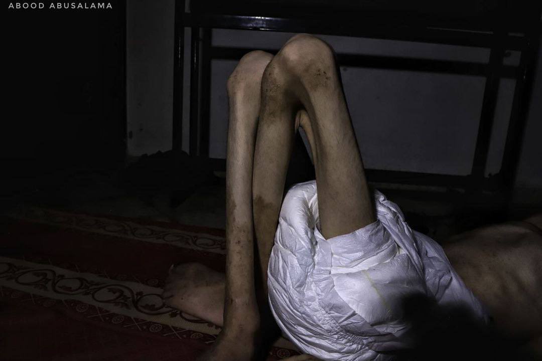 Patient in Gaza lacks medicines and food amid famine