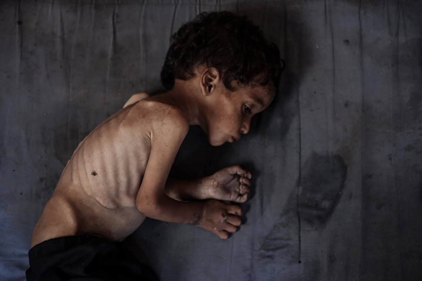 Three Children Die from Dehydration and Malnutrition in Gaza