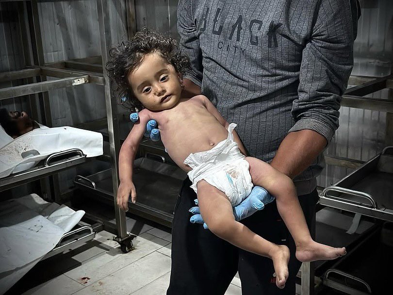 11-Month-Old Child Dies from Malnutrition in Gaza