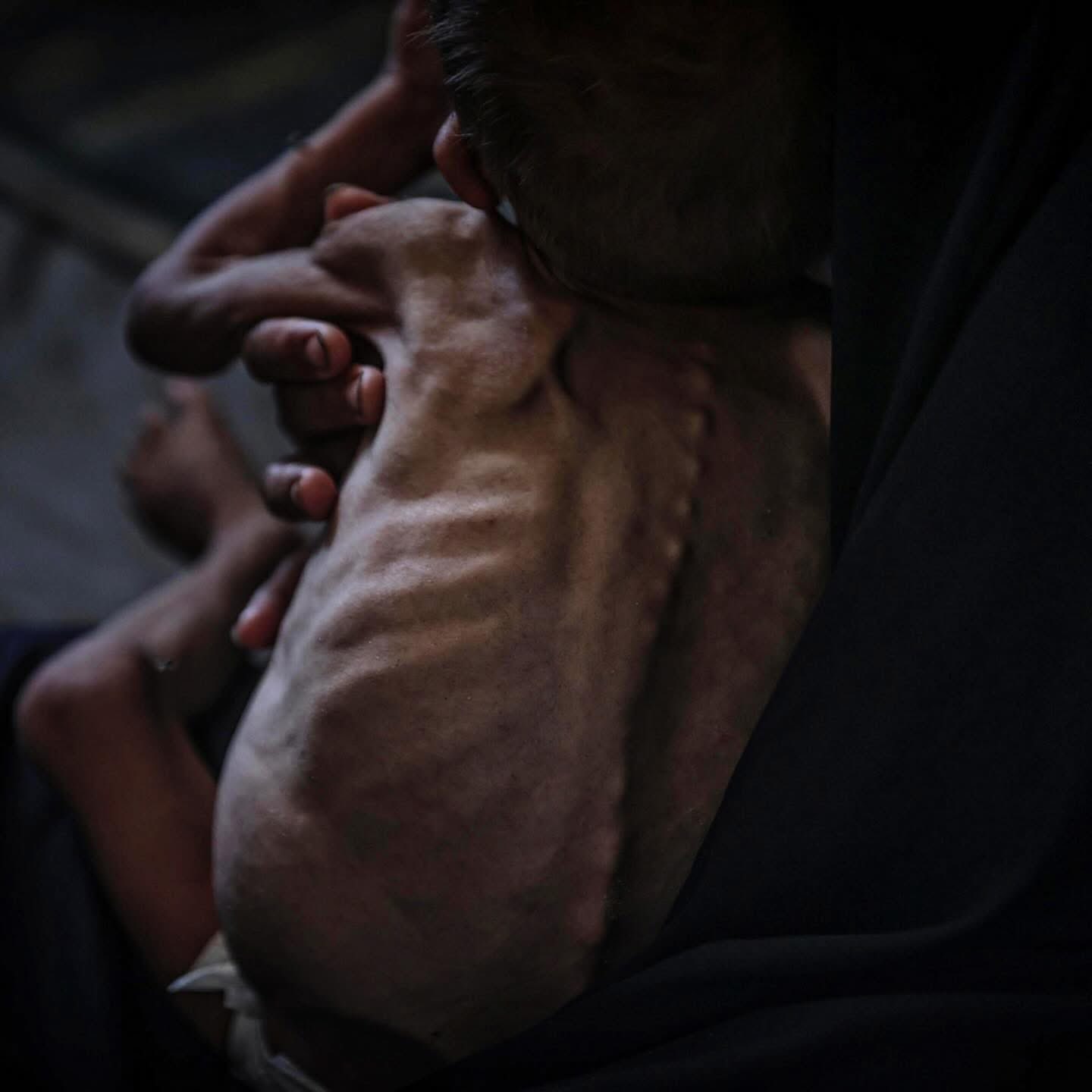 Gaza children face severe hunger and malnutrition amid Israeli blockade