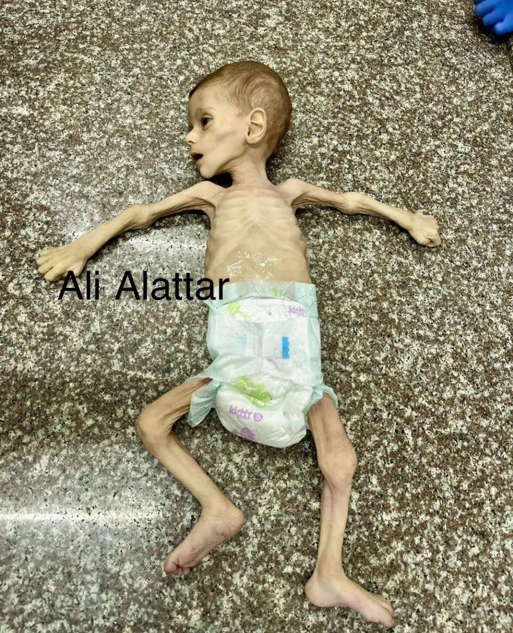 Palestinian Infant Death from Malnutrition in Gaza