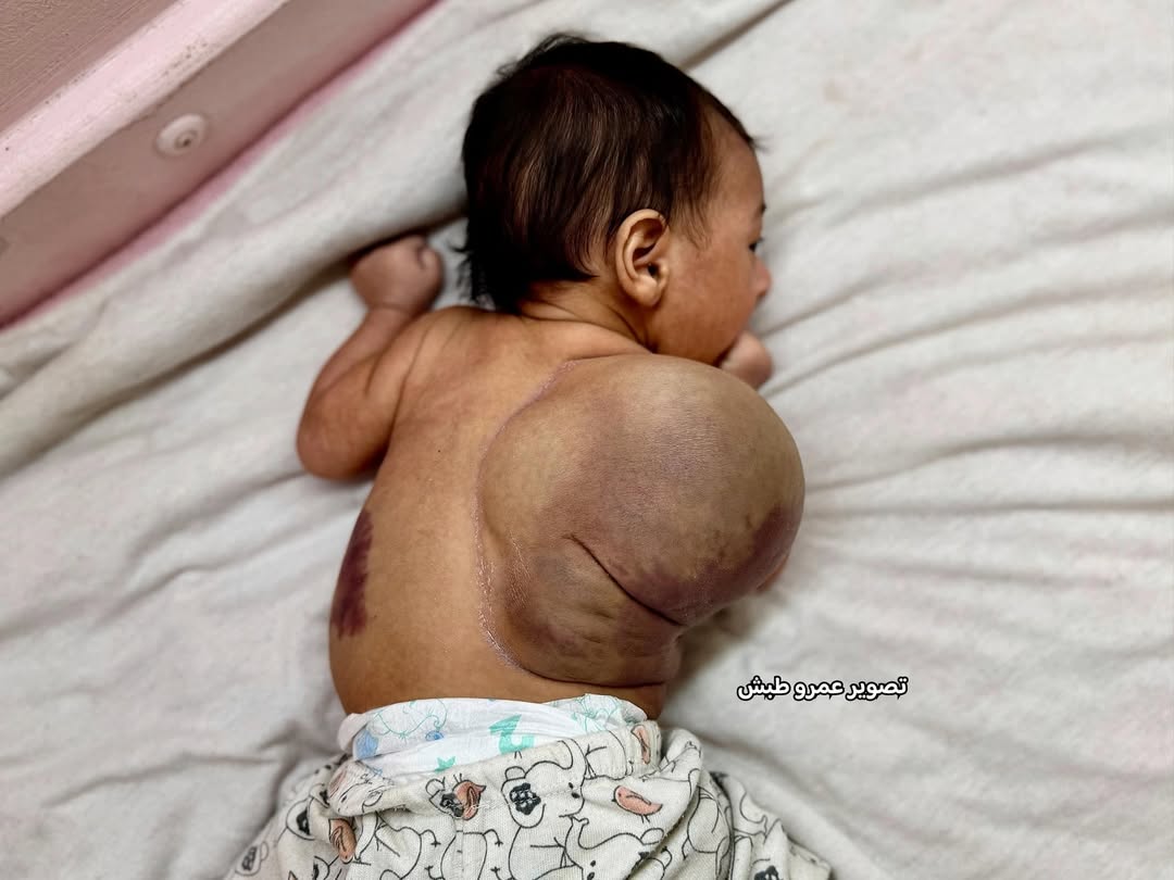 One-month-old Habiba needs urgent life-saving surgery outside Gaza