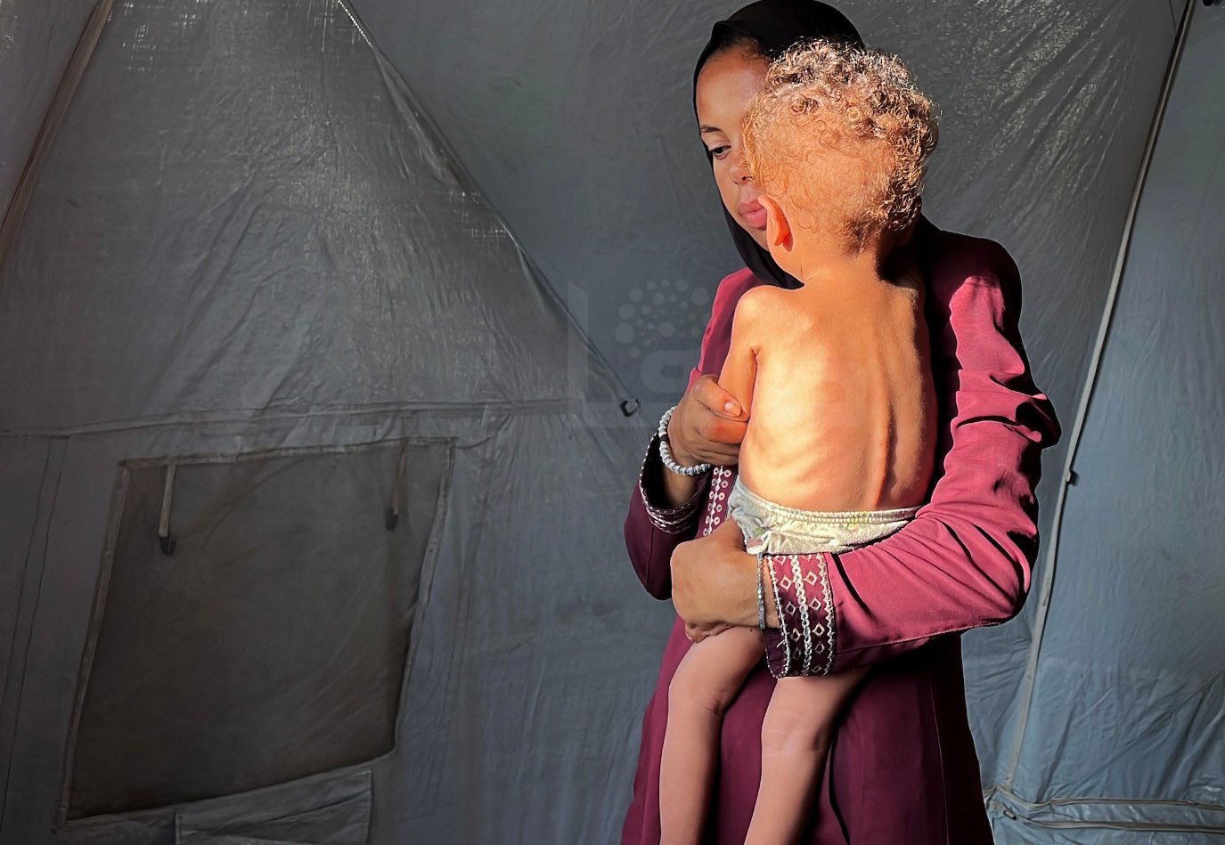 Baby’s Malnutrition Crisis in Gaza Blockade