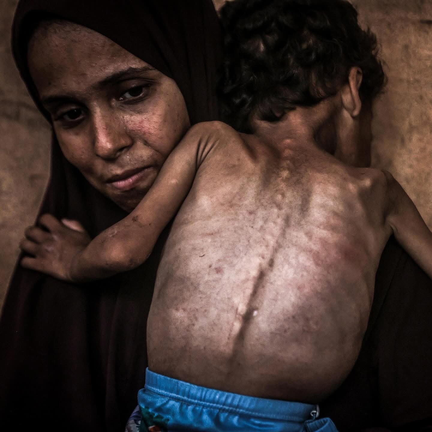 Two-year-old Palestinian child faces severe malnutrition in Gaza
