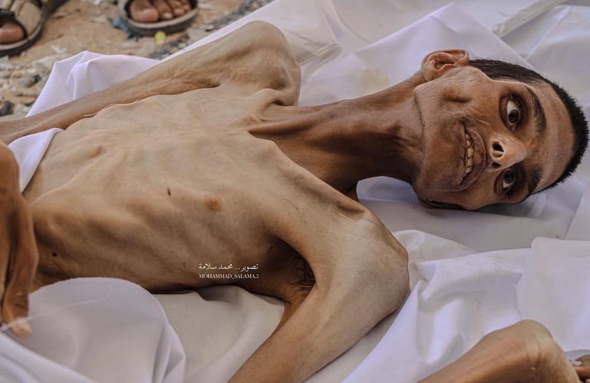 Gaza Strip Faces Systematic Starvation Crisis Deaths