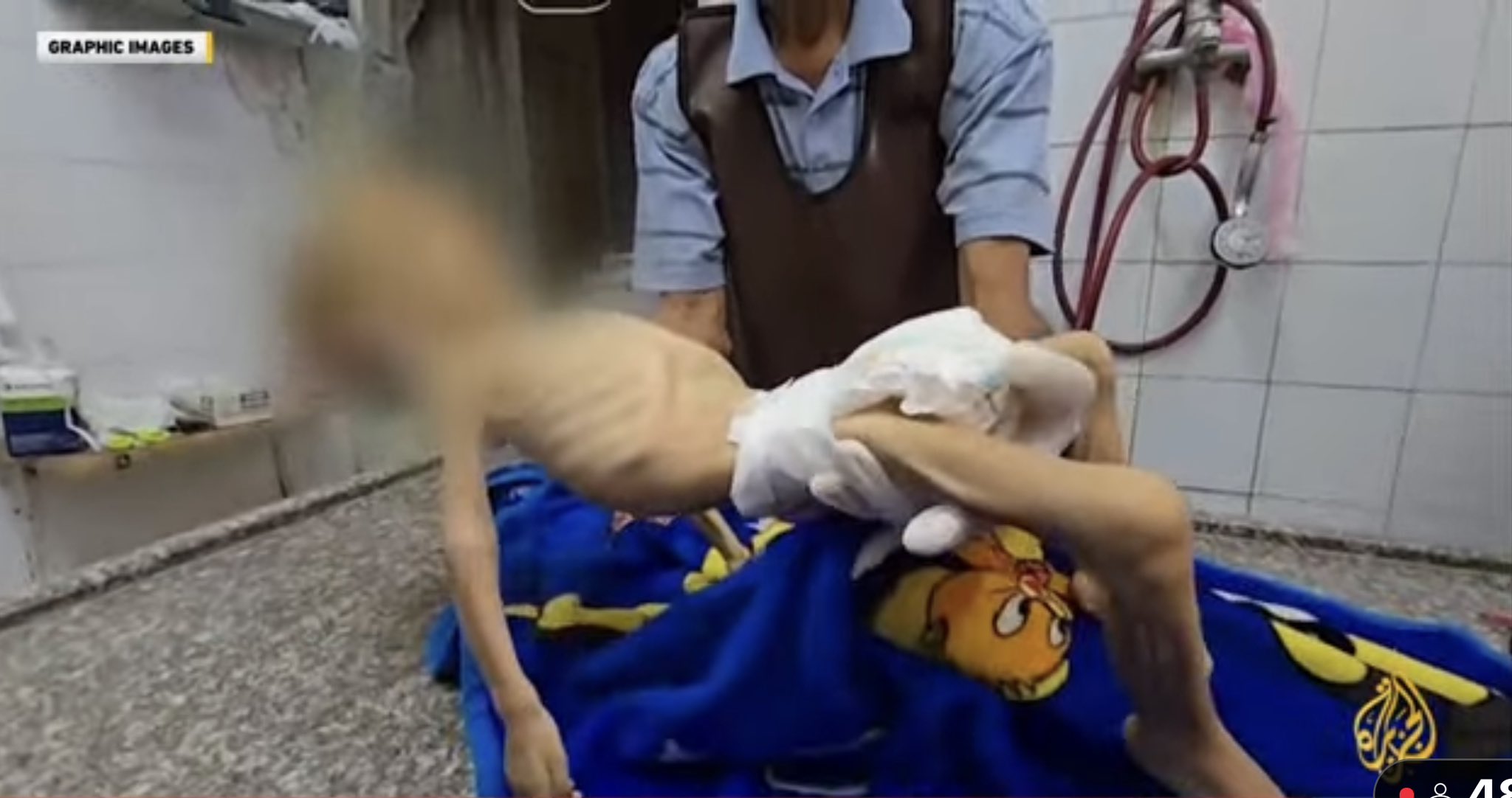 Palestinian Child Death from Malnutrition in Gaza