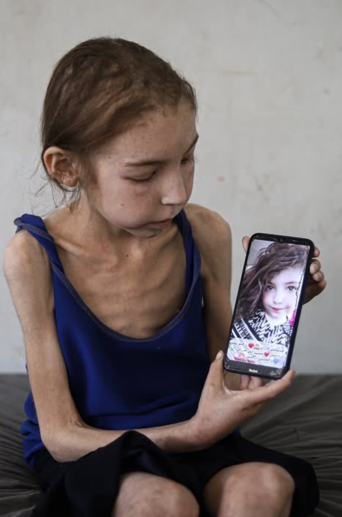 65000 Palestinian children hospitalized due to severe malnutrition