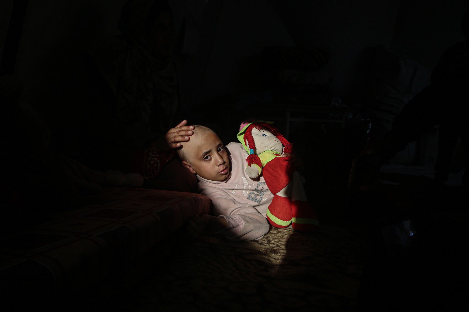 Child’s Hair Loss During Gaza Conflict: Medical Case
