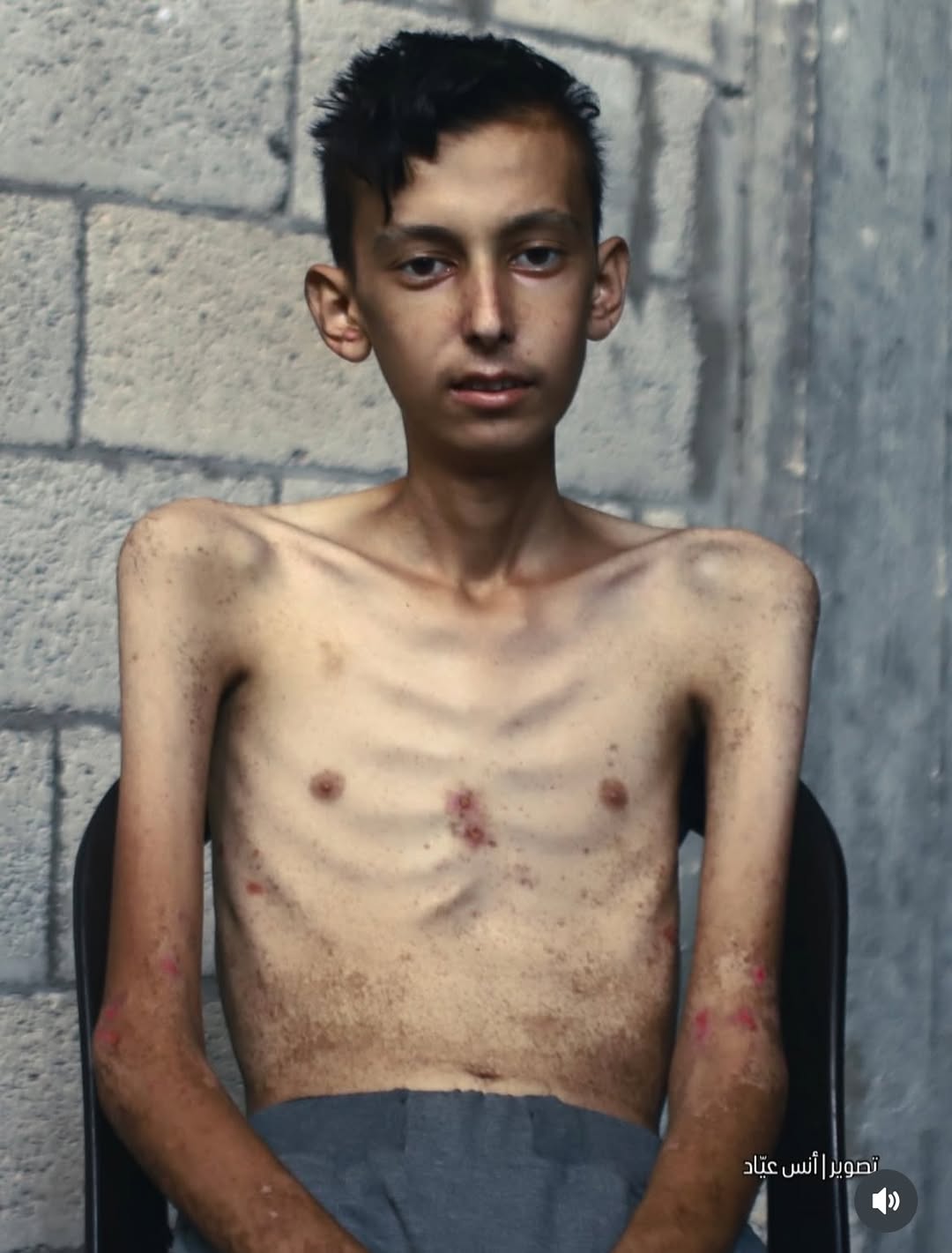 Palestinian Child Dies From Celiac Disease Malnutrition Gaza