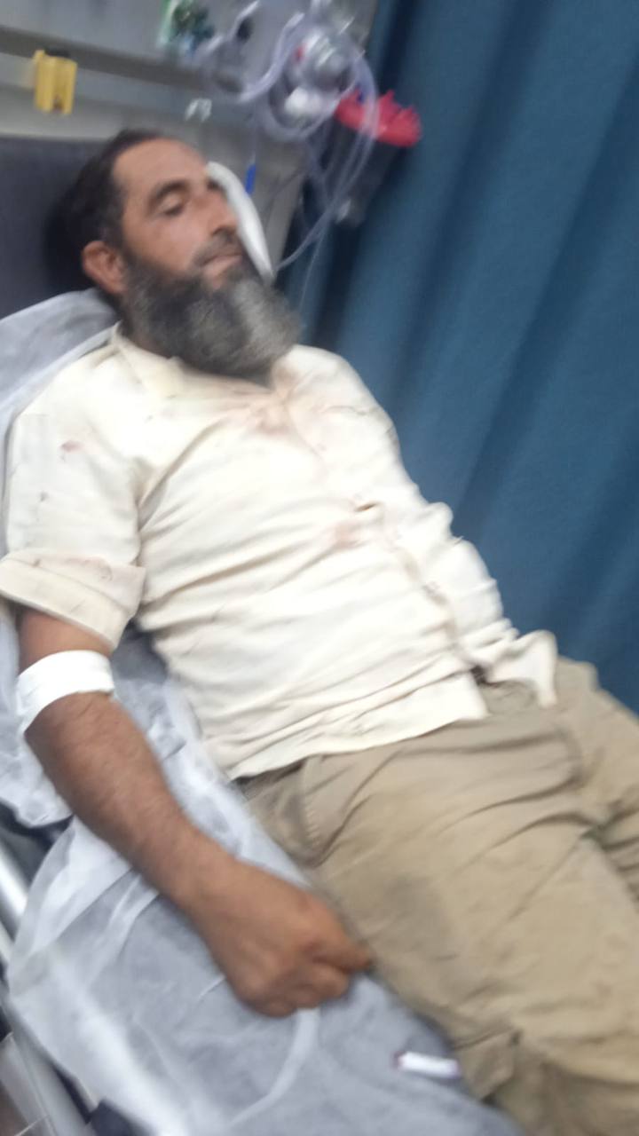 Palestinian man shot in head by Israeli settler while extinguishing fires