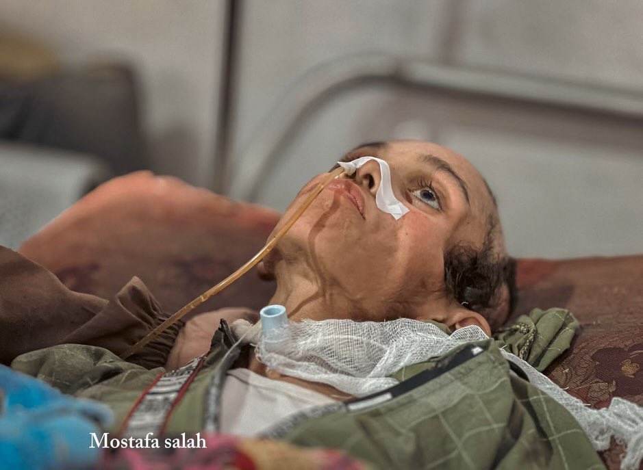 Child Suffering Severe Malnutrition Under Blockade Seeks Help
